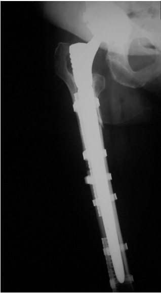 Radiograph of the ImplanTec Compression Cerclage and Stabilisation System fixing an isolated femur fracture.