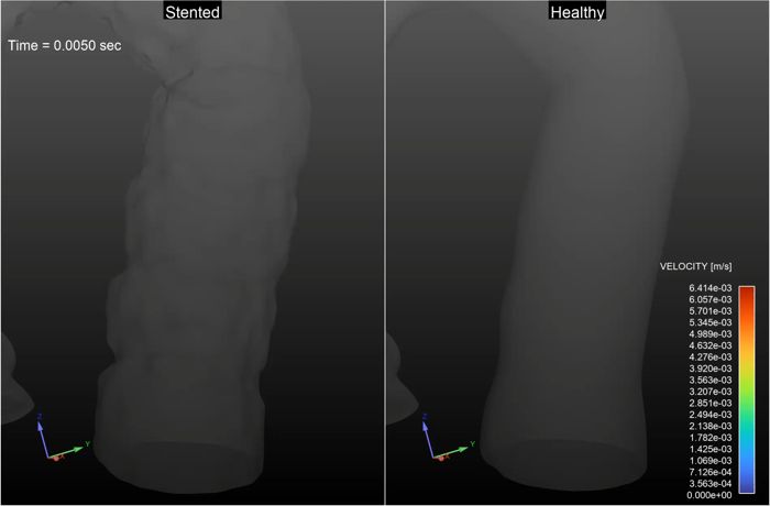 Zoomed-in flow field visualization of the stented aortic region, showing particle velocity and recirculation.