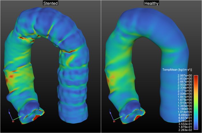 Time-averaged wall shear stress (TAWSS) visualization, showing the areas most likely to experience plaque buildup.