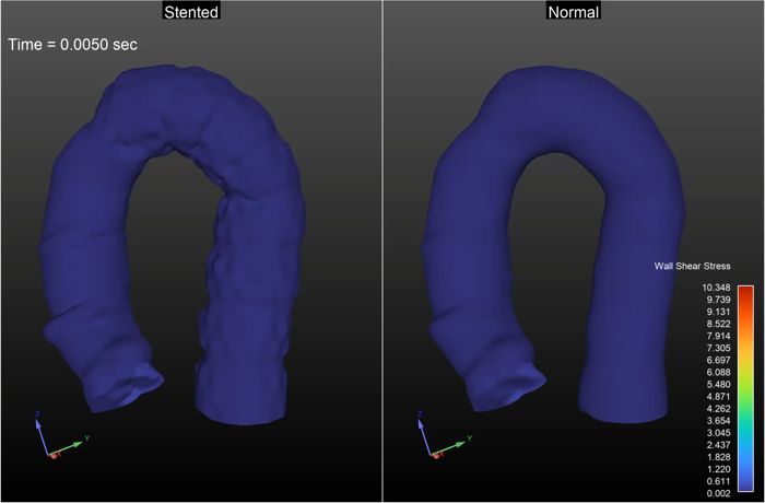 Wall shear stress visualization of the aorta over the cardiac cycle, showing high-stress regions in red at the stent location.